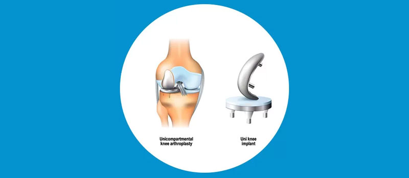 Best Surgeon For Unicondylar Partial Knee Replacement In Mumbai