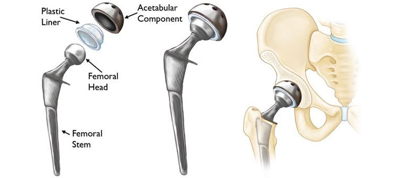 Best Hip And Knee Replacement Surgeon In Bombay Central