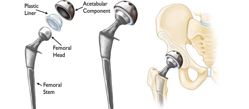 Best Hip Replacement Surgeon In Prabhadevi